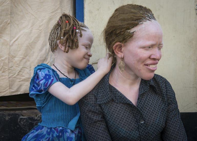 Zussen Judith en Winfrida hebben albinisme