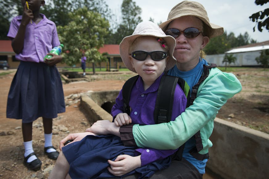 Zussen met albinisme, beschermd tegen de zon